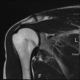 肩関節MRI